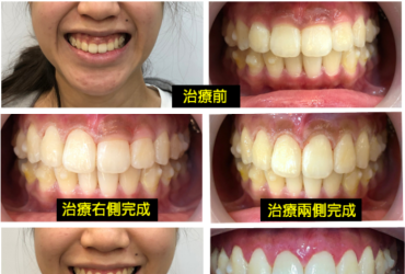 精緻微笑的最後一哩路：水雷射牙齦美容